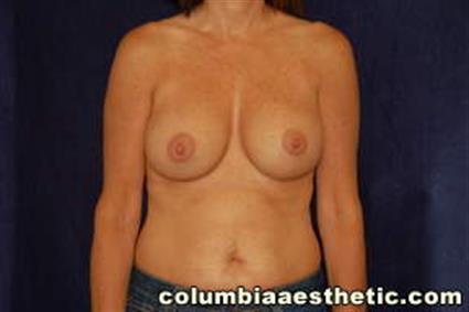 Breast Augmentation Patient Photo - Case 6 - after view-0