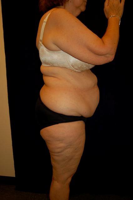 Abdominoplasty (Tummy Tuck) Patient Photo - Case 60 - before view-1