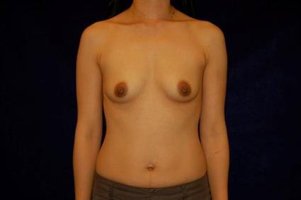 Breast Augmentation Patient Photo - Case 62 - before view-