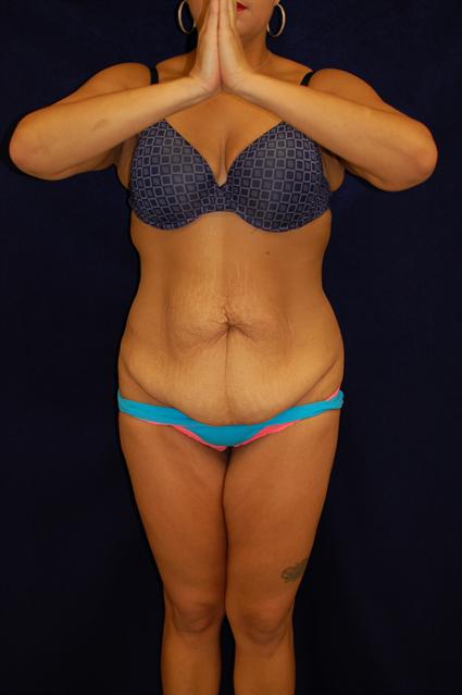 Abdominoplasty (Tummy Tuck) Patient Photo - Case 65 - before view-0