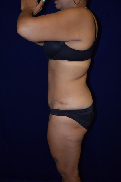 Abdominoplasty (Tummy Tuck) Patient Photo - Case 65 - after view-1