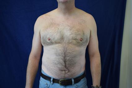 Male Breast Reduction (Gynecomastia) Patient Photo - Case 69 - after view