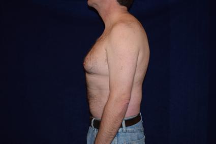 Male Breast Reduction (Gynecomastia) Patient Photo - Case 69 - before view-1