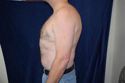 Male Breast Reduction (Gynecomastia) Patient Photo - Case 69 - after view-1