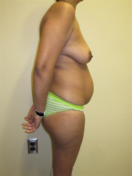 Abdominoplasty (Tummy Tuck) Patient Photo - Case 71 - before view-3