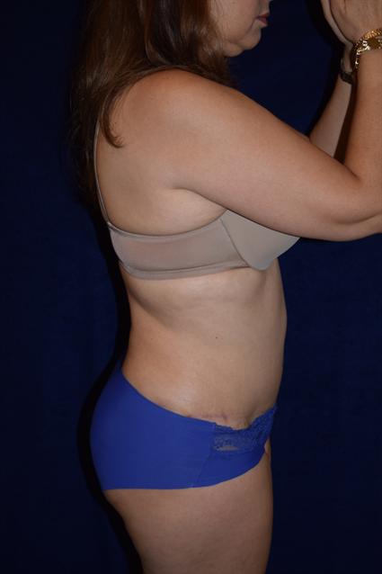 Abdominoplasty (Tummy Tuck) Patient Photo - Case 73 - after view-1