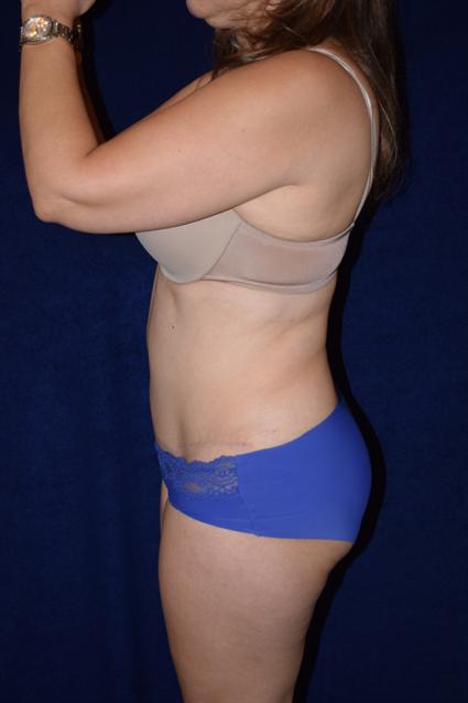 Abdominoplasty (Tummy Tuck) Patient Photo - Case 73 - after view-4