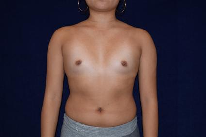 Breast Augmentation - Case 75 - Before
