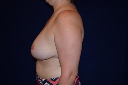Breast Reduction Patient Photo - Case 76 - after view-1