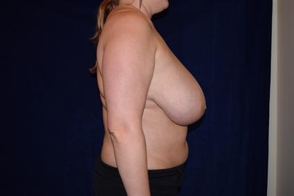 Breast Reduction Patient Photo - Case 76 - before view-3
