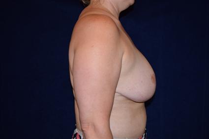 Breast Reduction Patient Photo - Case 76 - after view-3