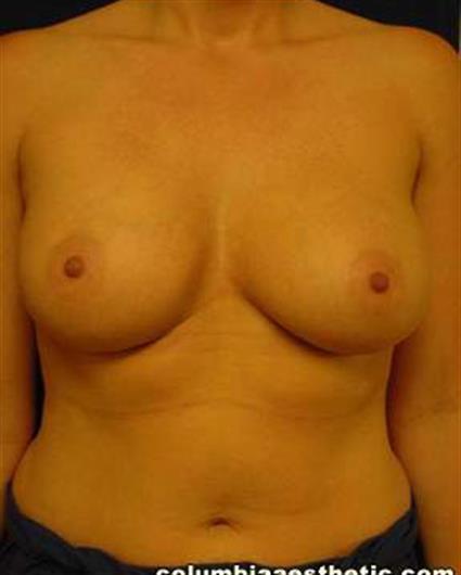 Breast Augmentation Patient Photo - Case 9 - after view