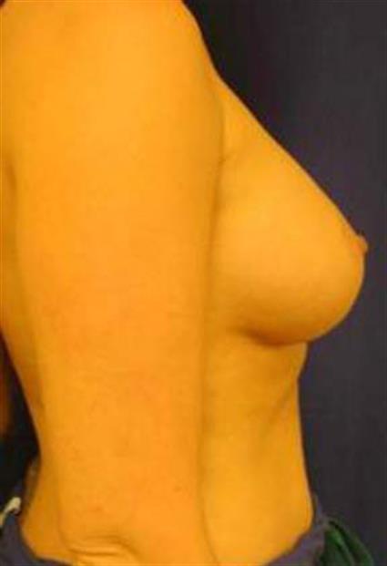 Breast Augmentation Patient Photo - Case 9 - after view-1
