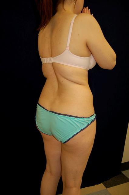 Liposuction Patient Photo - Case 61 - before view-6
