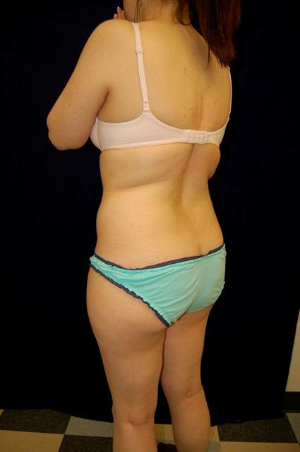 Liposuction Patient Photo - Case 61 - before view-4
