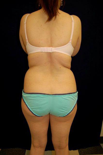 Liposuction Patient Photo - Case 61 - before view-1