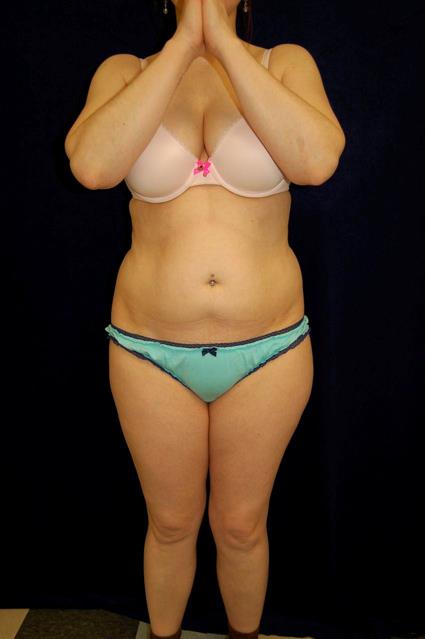 Liposuction Patient Photo - Case 61 - before view-