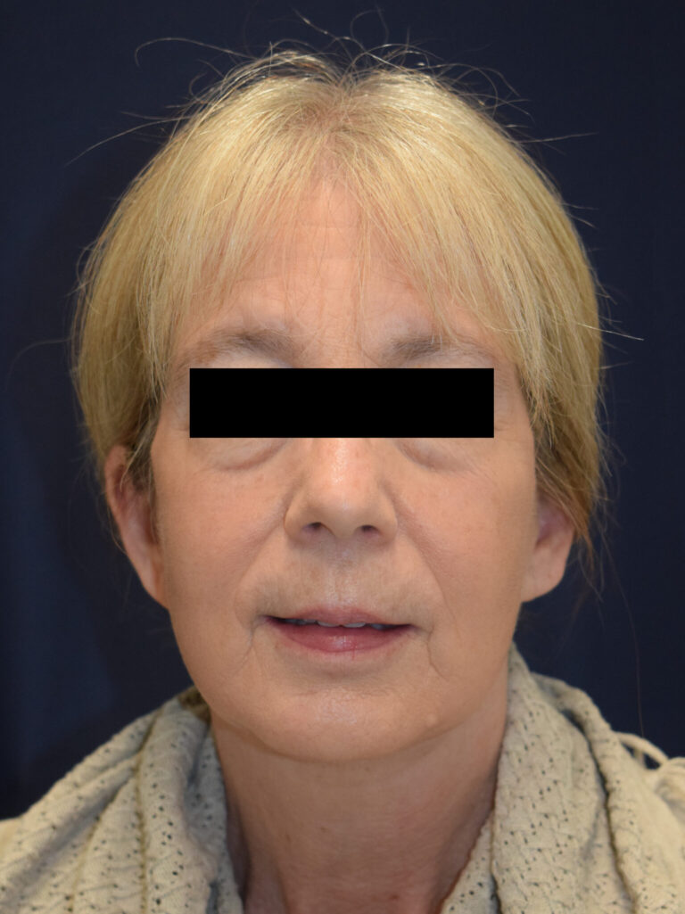 Facelift Surgery - Case 2613 - After