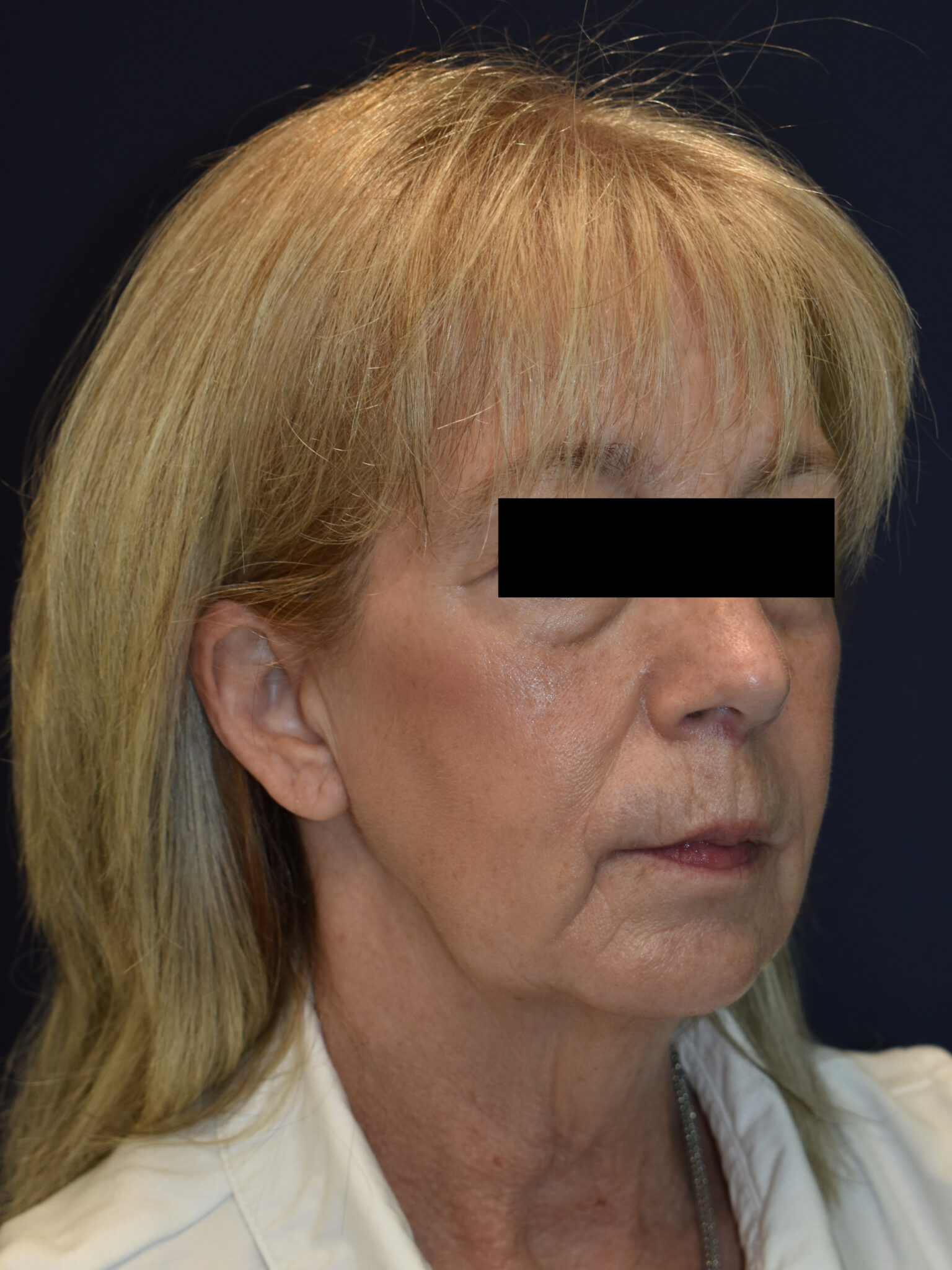 Facelift Surgery Patient Photo - Case 2613 - before view-1