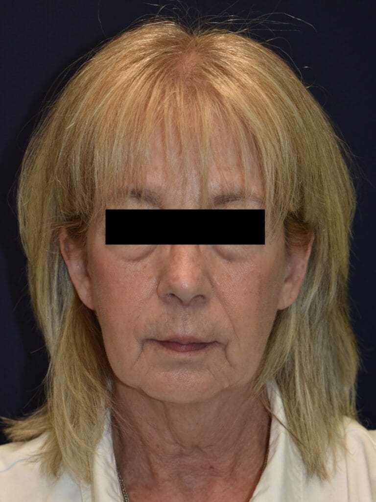 Facelift Surgery - Case 2613 - Before