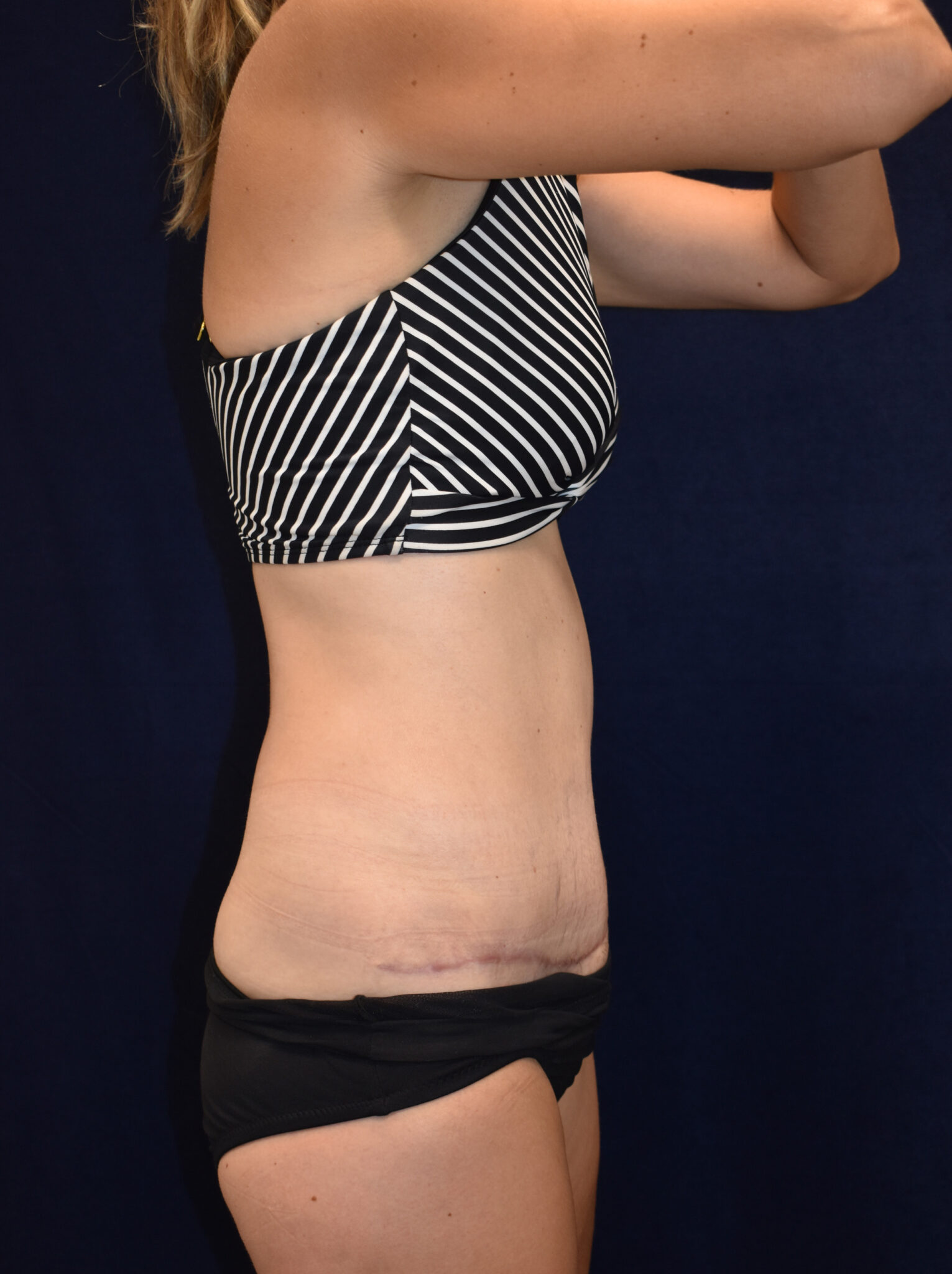 Abdominoplasty (Tummy Tuck) Patient Photo - Case 2621 - after view-1