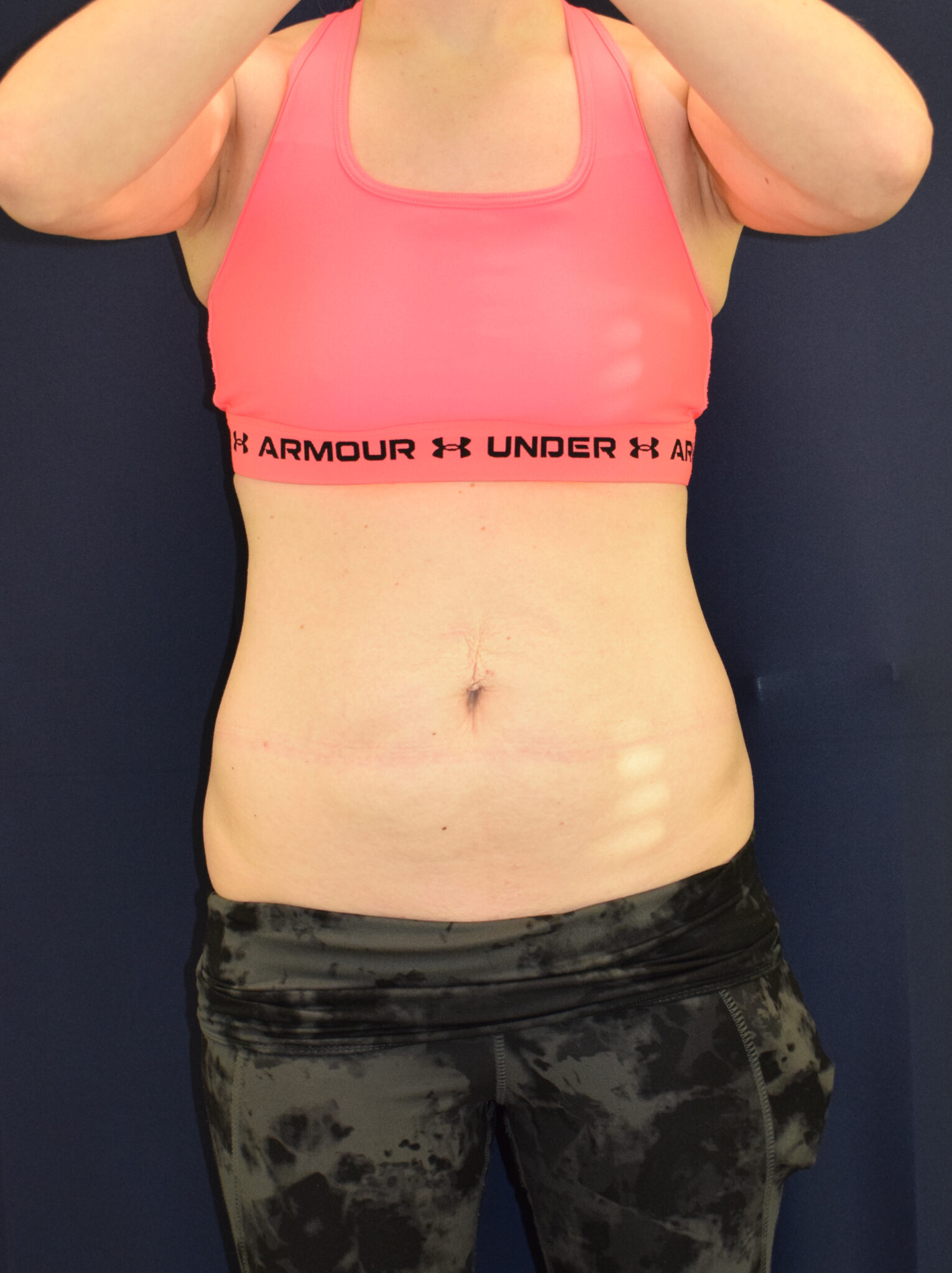 Abdominoplasty (Tummy Tuck) Patient Photo - Case 2621 - before view-