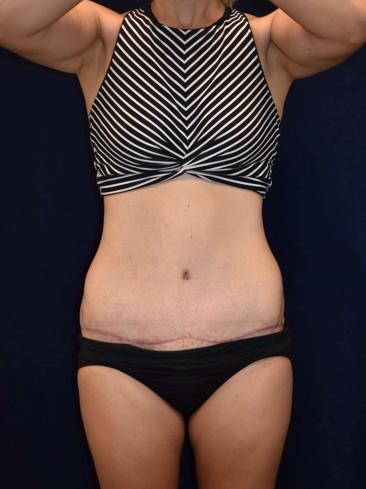 Abdominoplasty (Tummy Tuck) Patient Photo - Case 2621 - after view