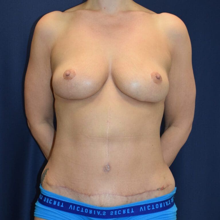 Abdominoplasty (Tummy Tuck) - Case 2634 - After