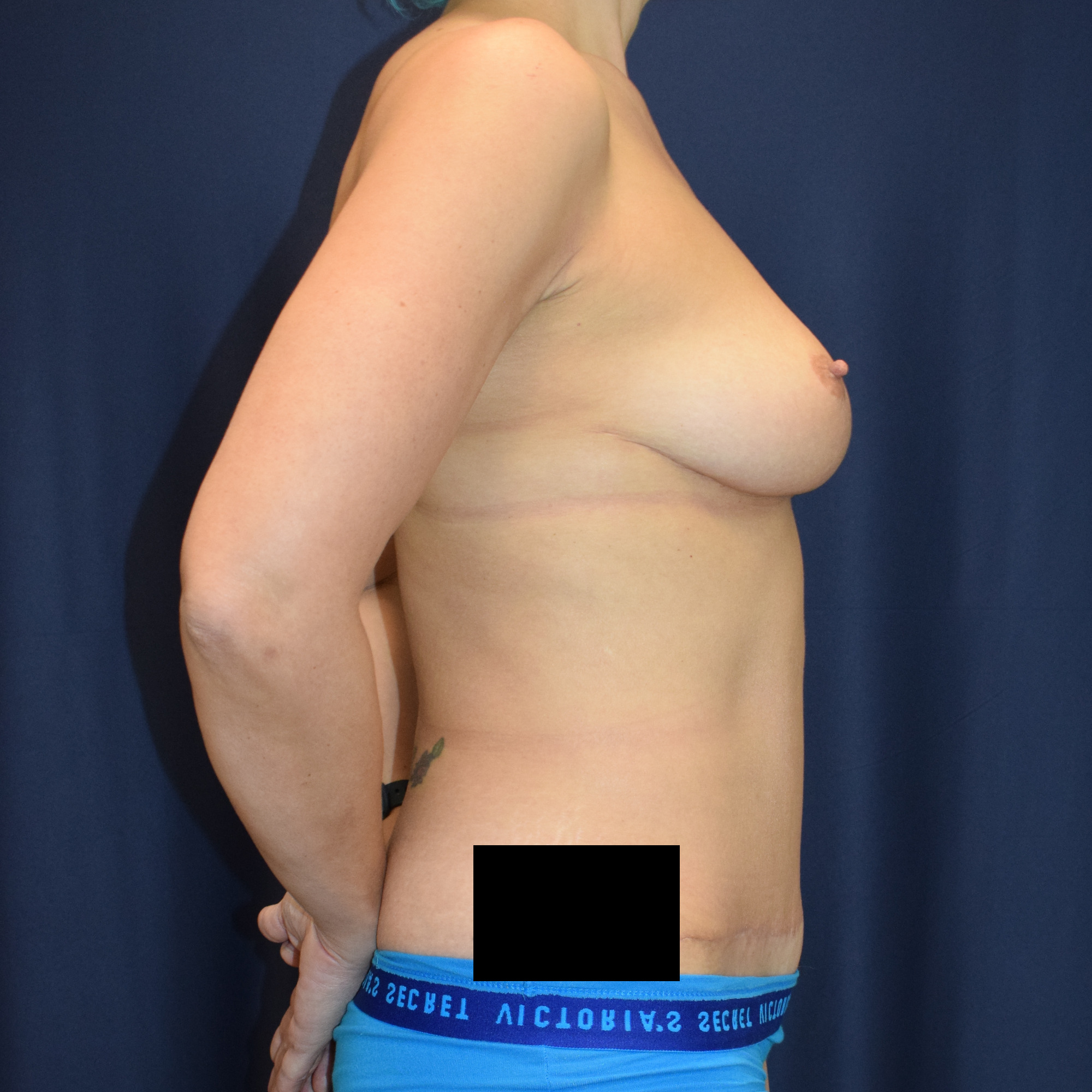 Abdominoplasty (Tummy Tuck) Patient Photo - Case 2634 - after view-2