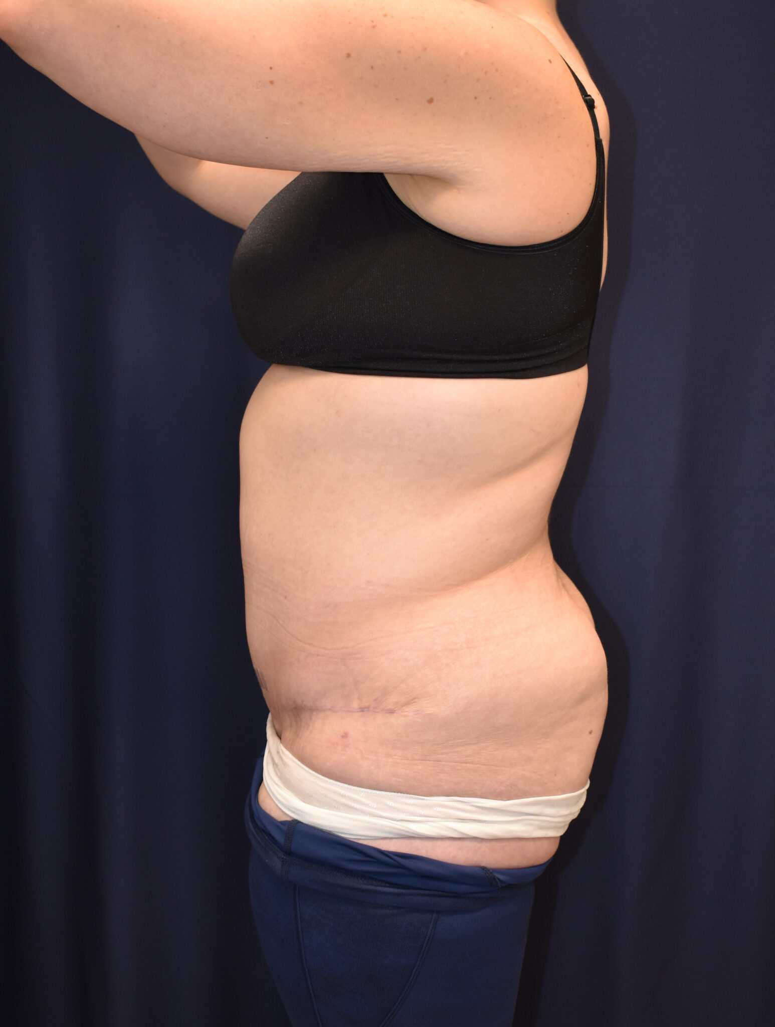 Abdominoplasty (Tummy Tuck) Patient Photo - Case 2655 - after view-2