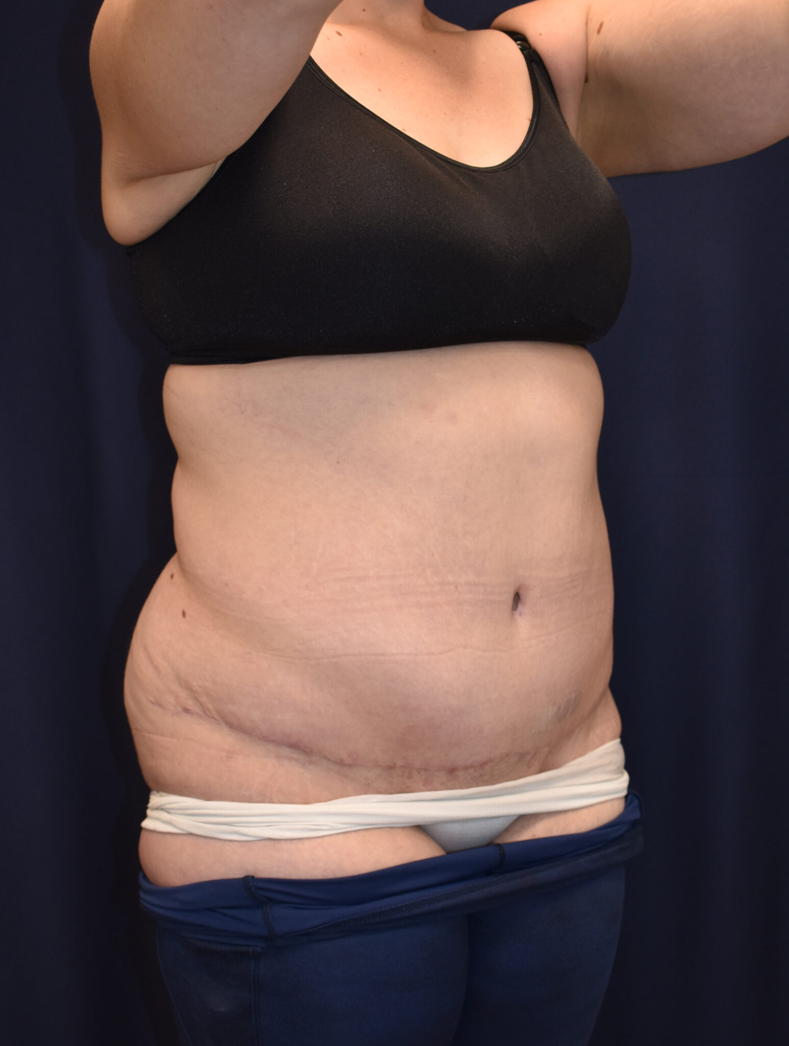 Abdominoplasty (Tummy Tuck) Patient Photo - Case 2655 - after view-1