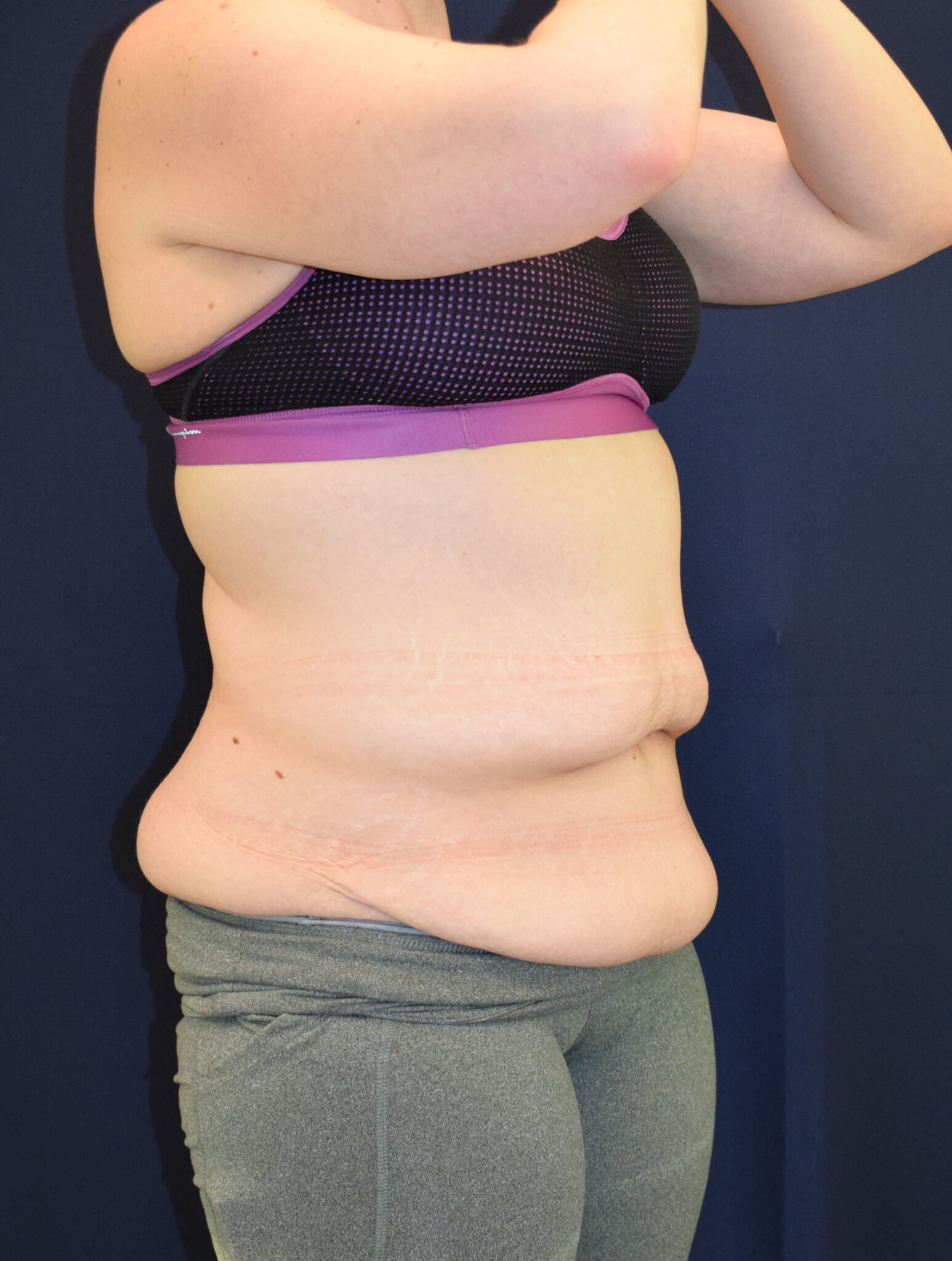 Abdominoplasty (Tummy Tuck) Patient Photo - Case 2655 - before view-1