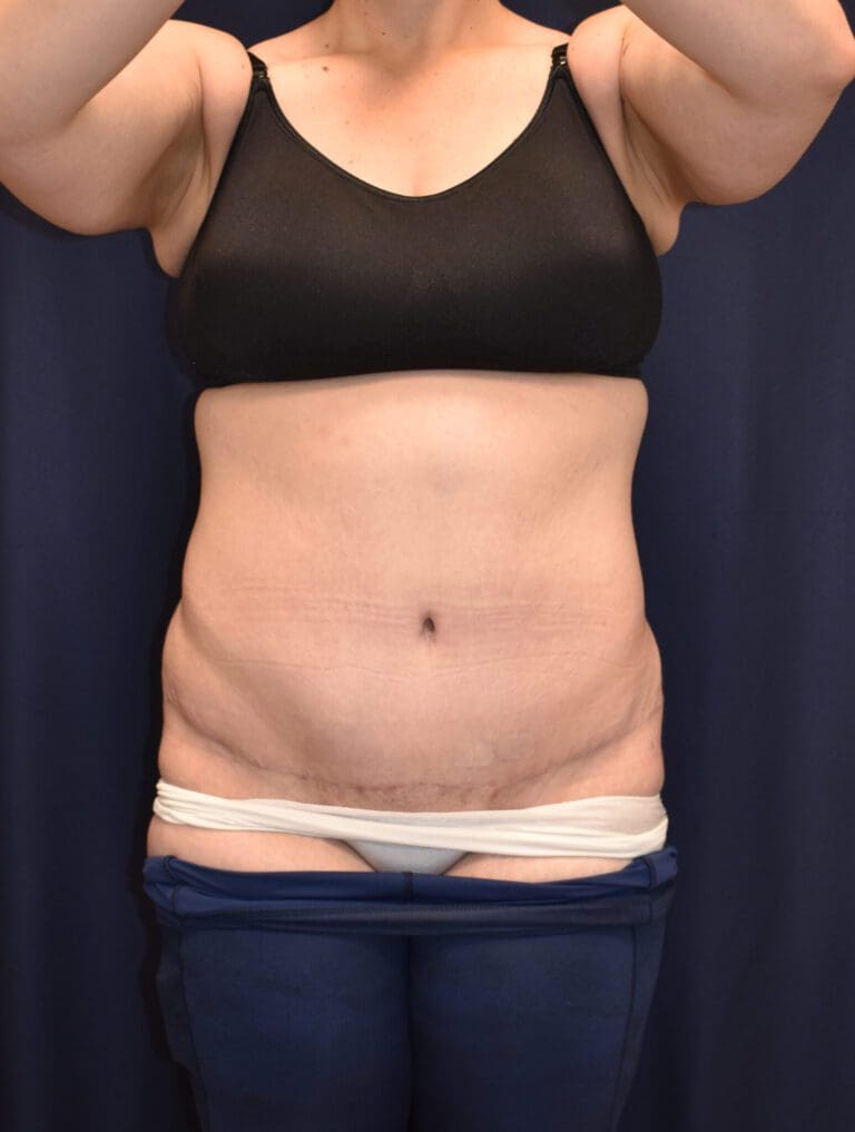 Abdominoplasty (Tummy Tuck) - Case 2655 - After