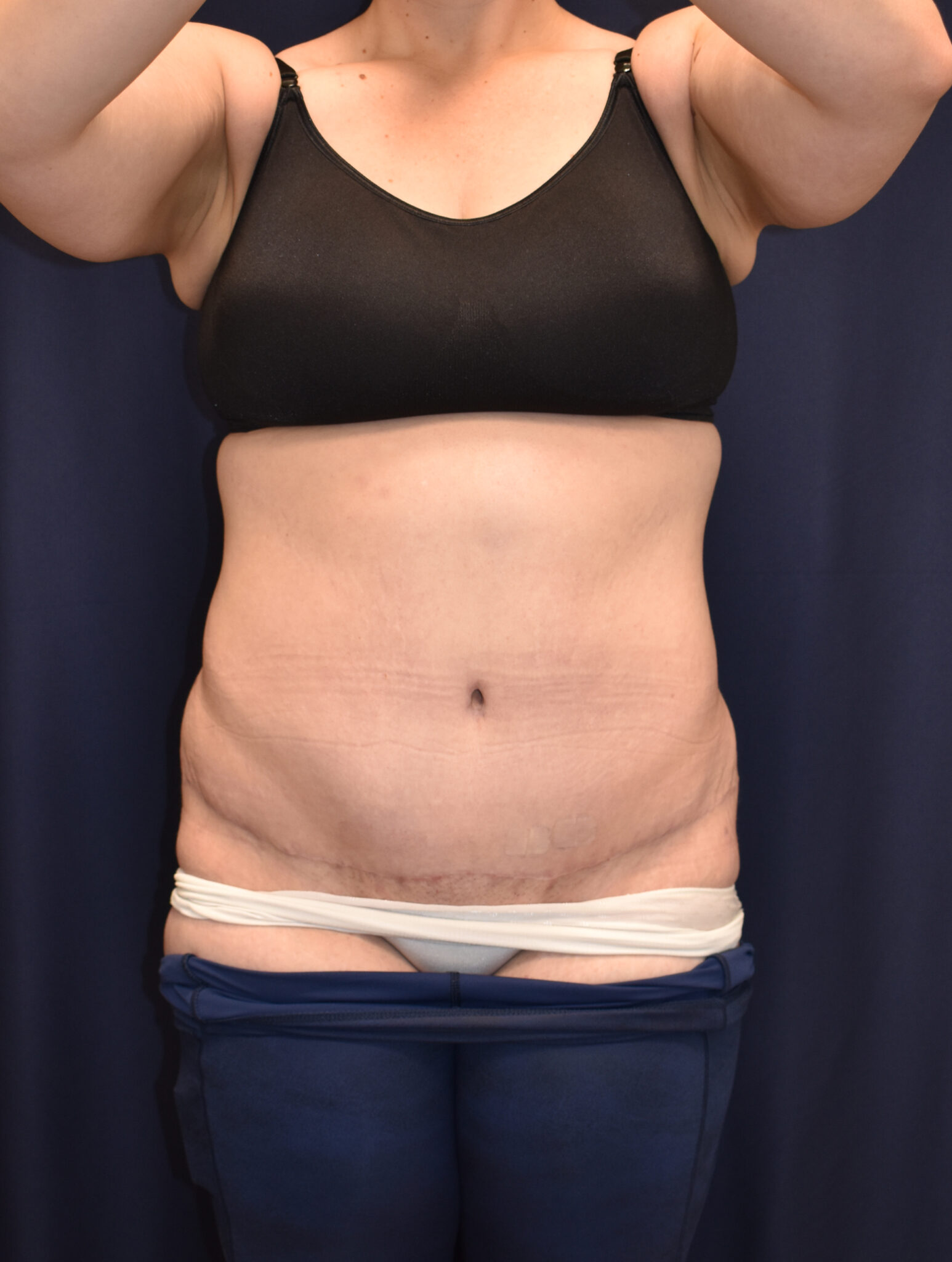 Abdominoplasty (Tummy Tuck) Patient Photo - Case 2655 - after view-0