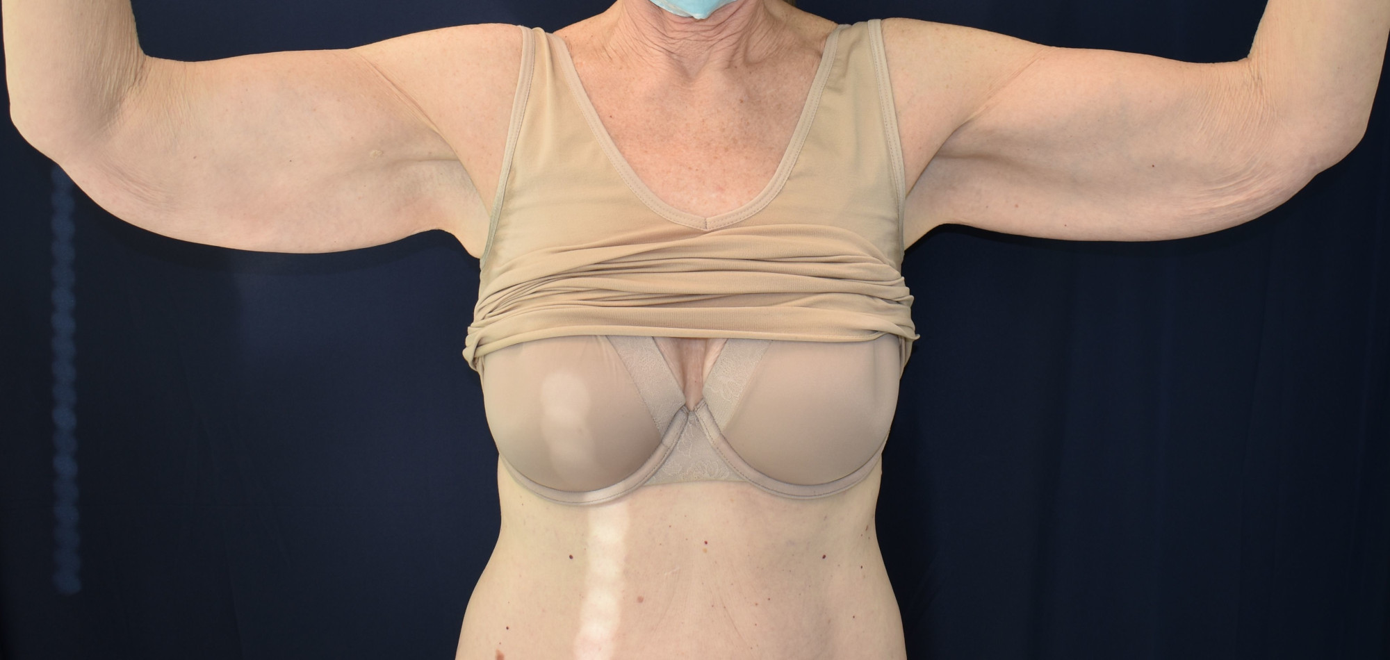 Abdominoplasty (Tummy Tuck) Patient Photo - Case 2663 - before view-2