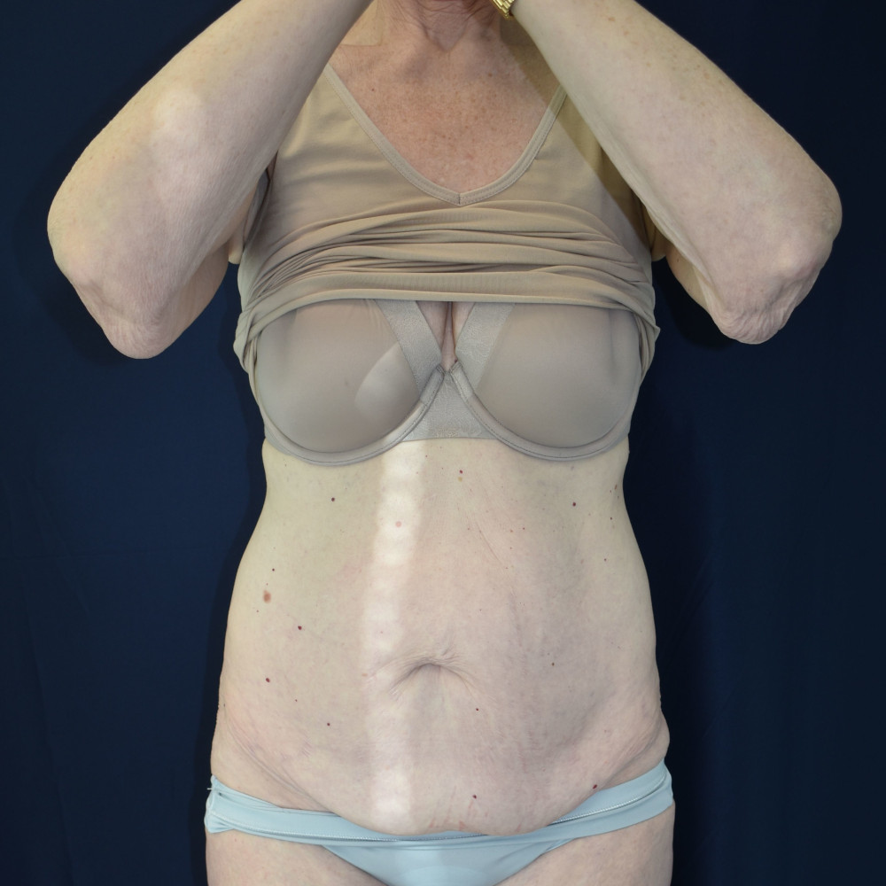 Abdominoplasty (Tummy Tuck) Patient Photo - Case 2663 - before view-