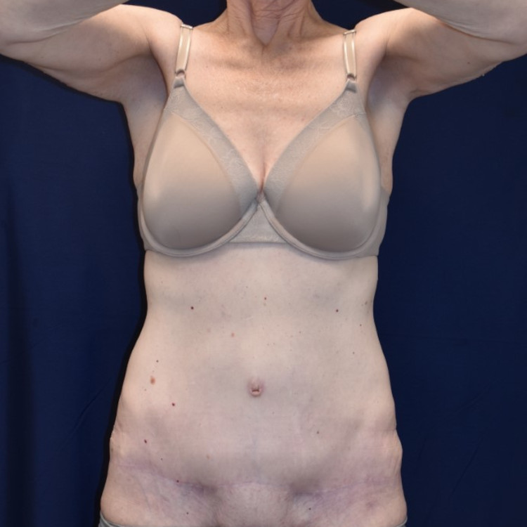 Abdominoplasty (Tummy Tuck) Patient Photo - Case 2663 - after view