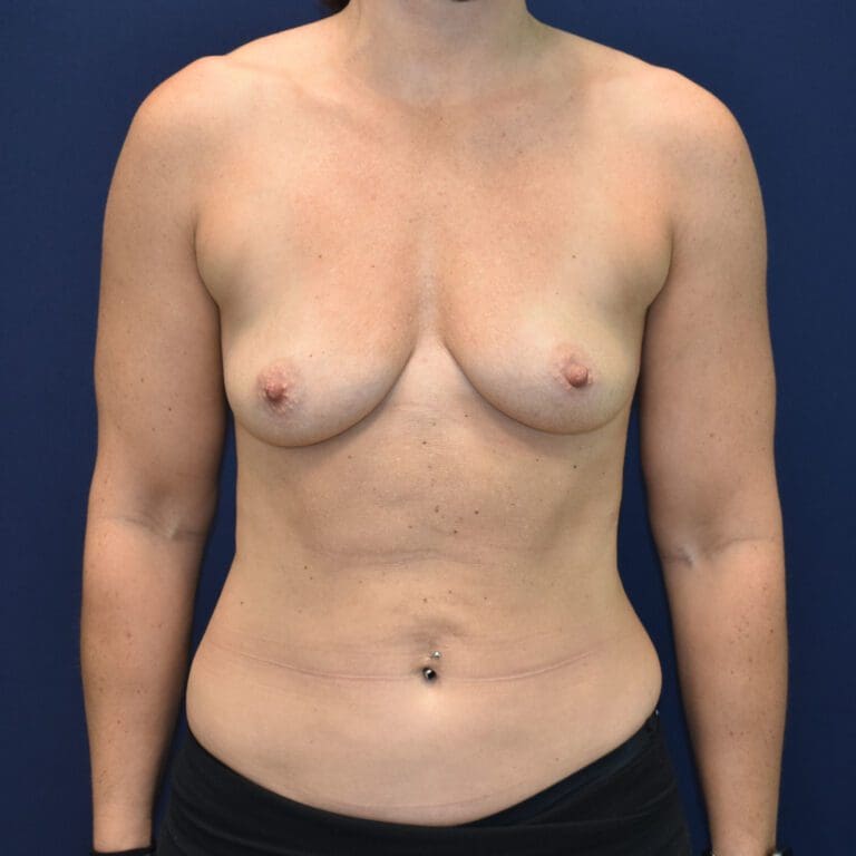 Breast Augmentation - Case 2881 - Before