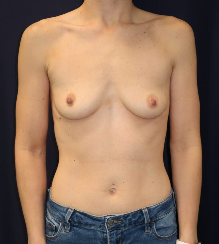 Breast Augmentation - Case 2895 - Before