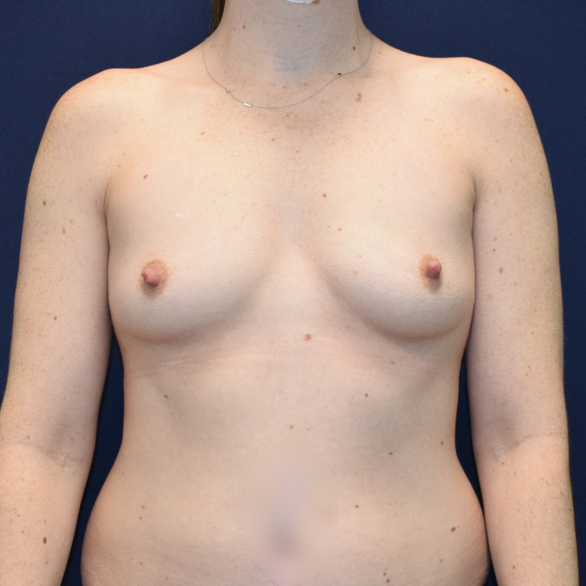 Breast Augmentation Patient Photo - Case 2914 - before view-0
