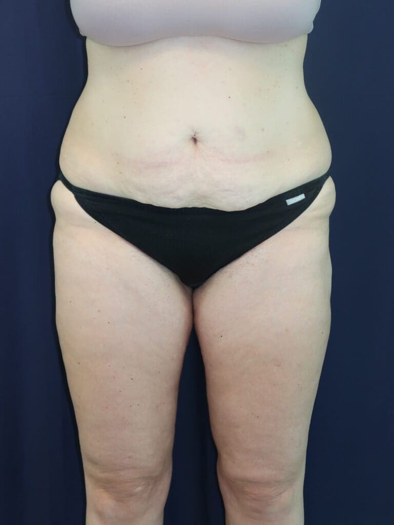 Liposuction - Case 2942 - After