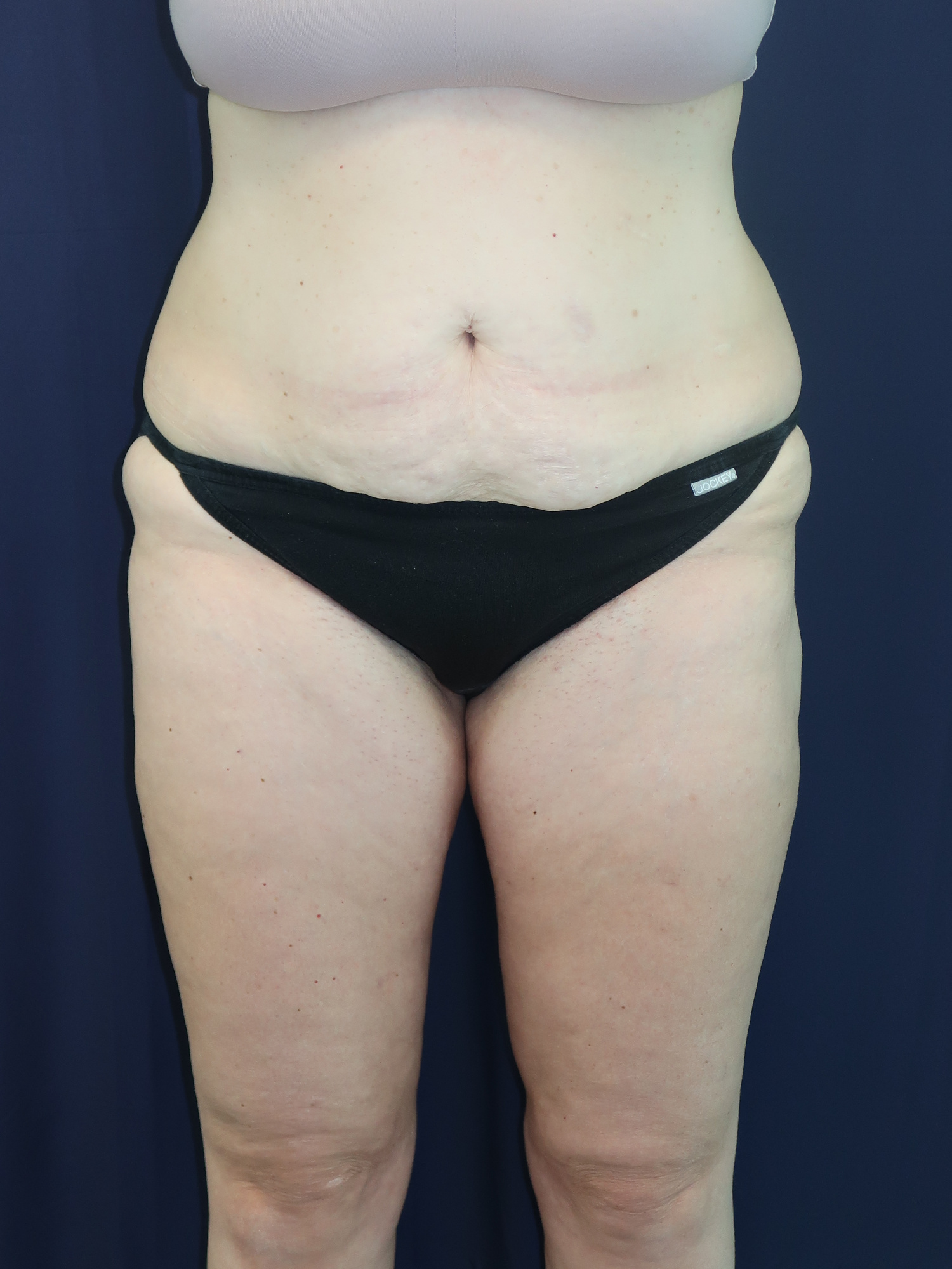 Liposuction Patient Photo - Case 2942 - after view-0