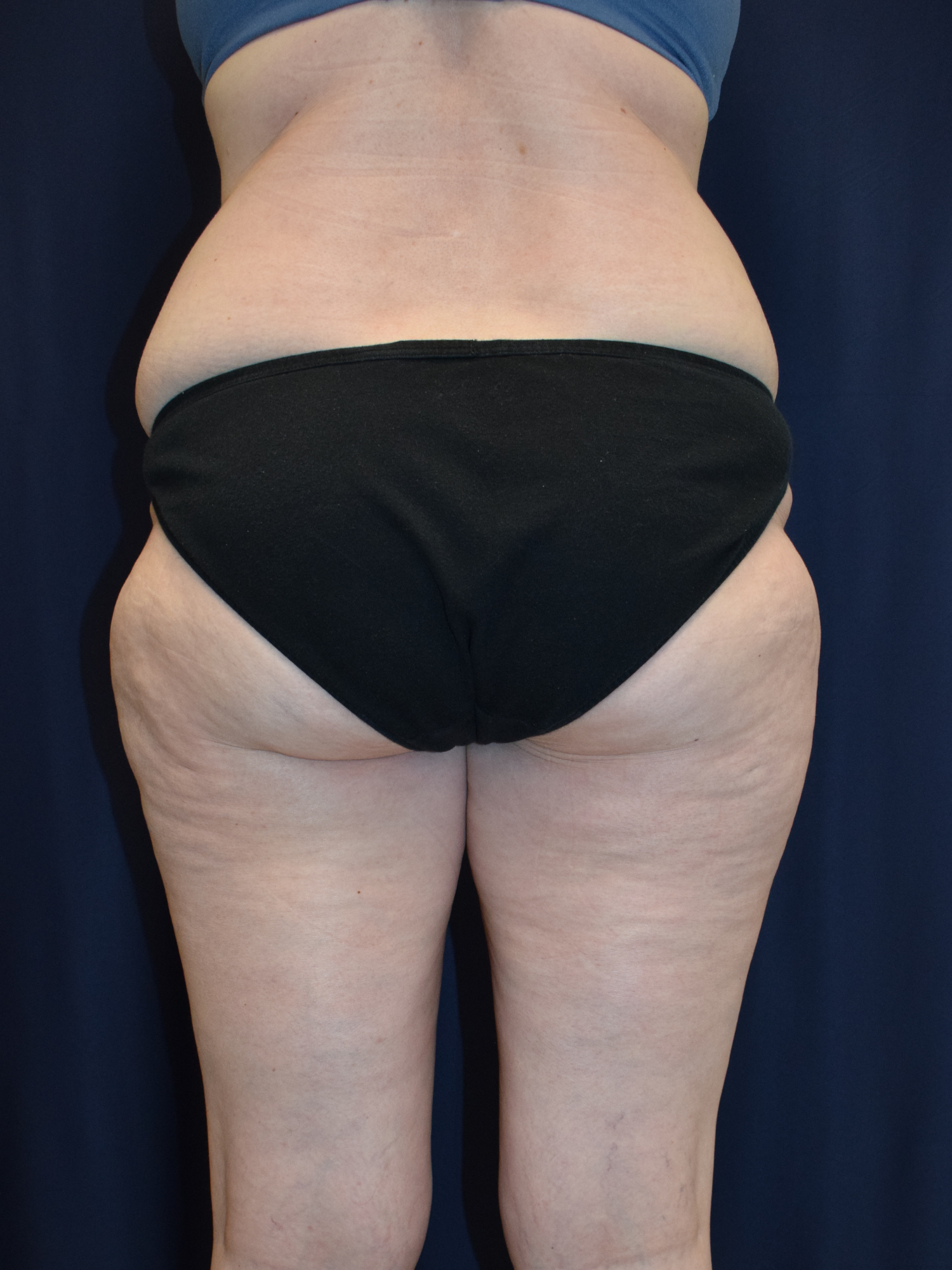 Liposuction Patient Photo - Case 2942 - before view-1