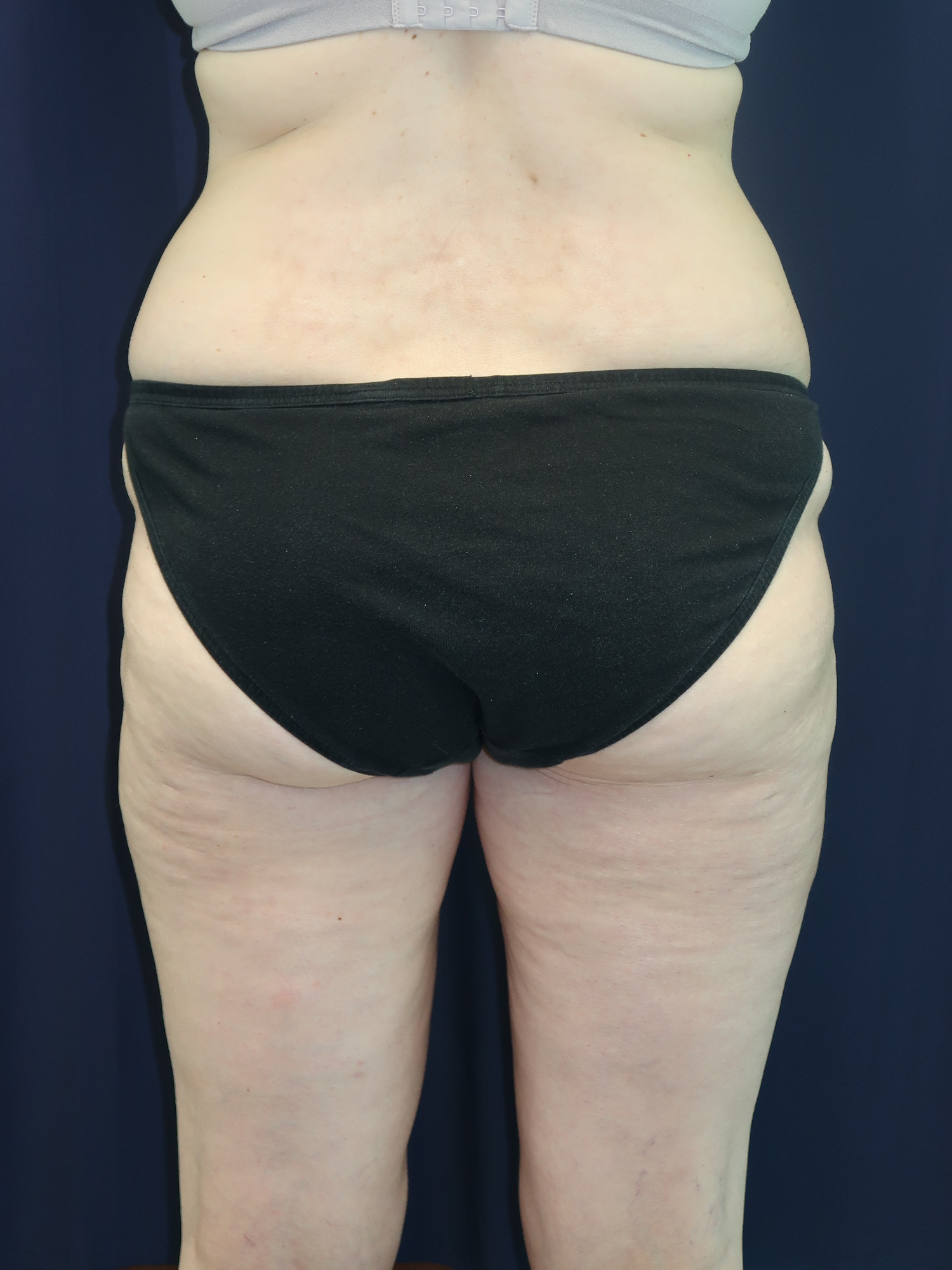 Liposuction Patient Photo - Case 2942 - after view-1
