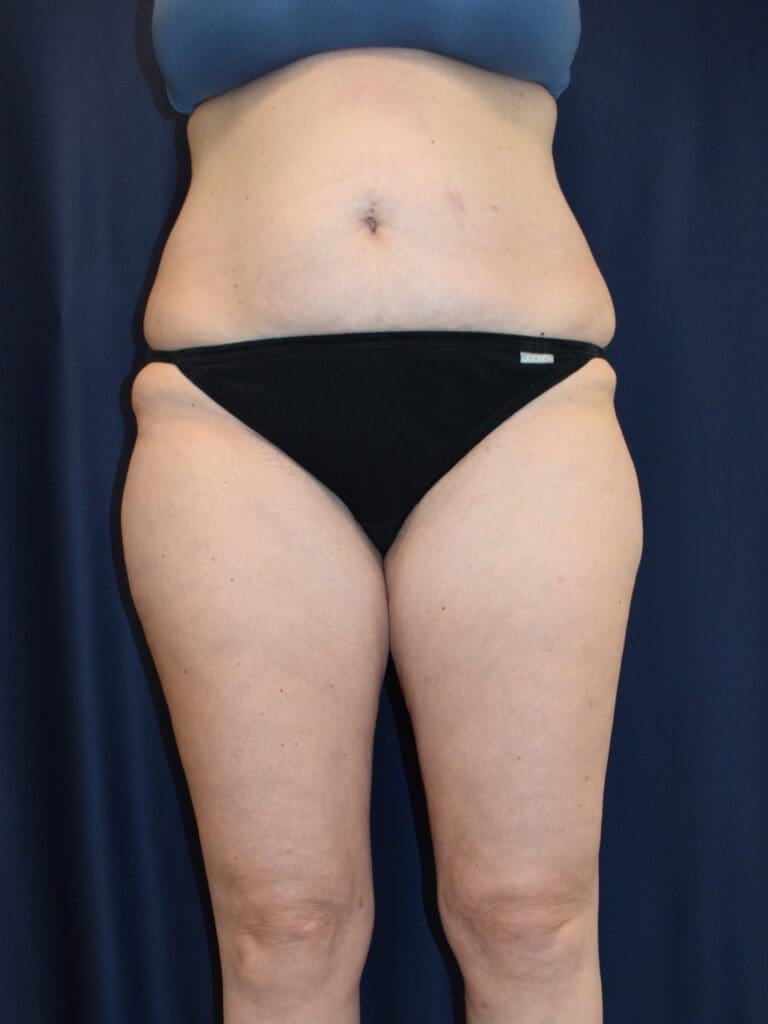 Liposuction - Case 2942 - Before