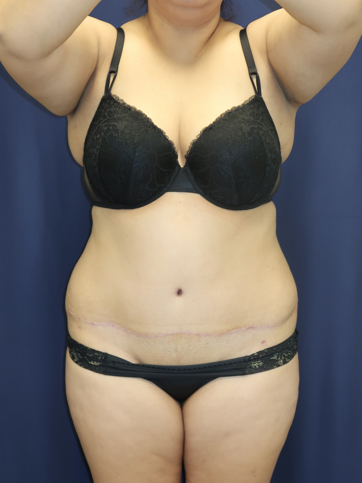 Abdominoplasty (Tummy Tuck) Patient Photo - Case 2969 - after view-0