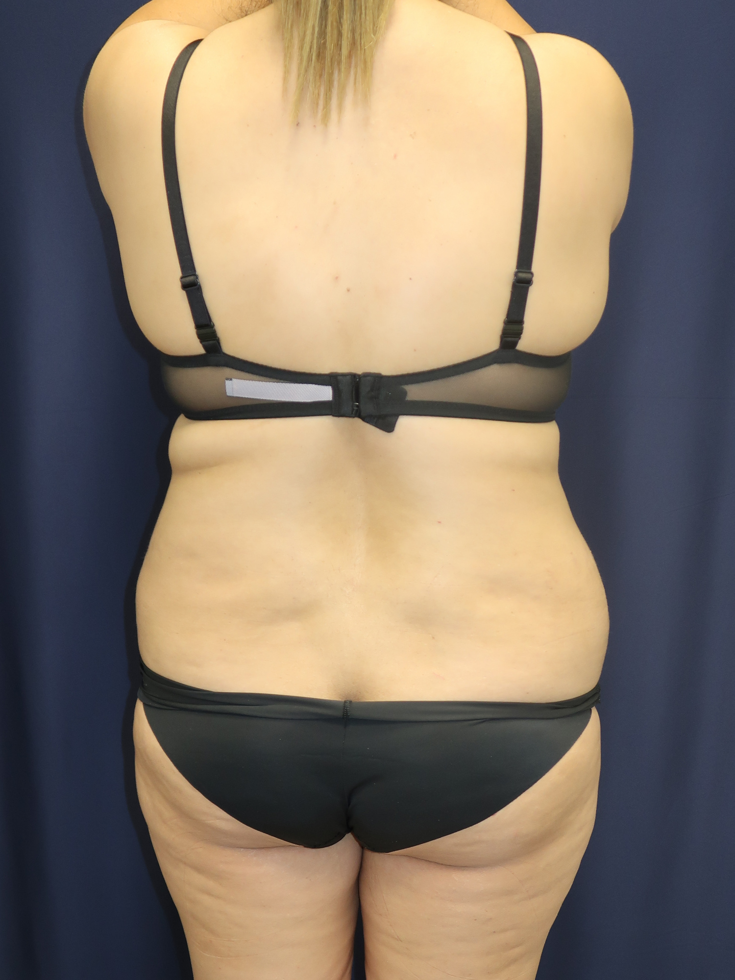 Abdominoplasty (Tummy Tuck) Patient Photo - Case 2969 - after view-2