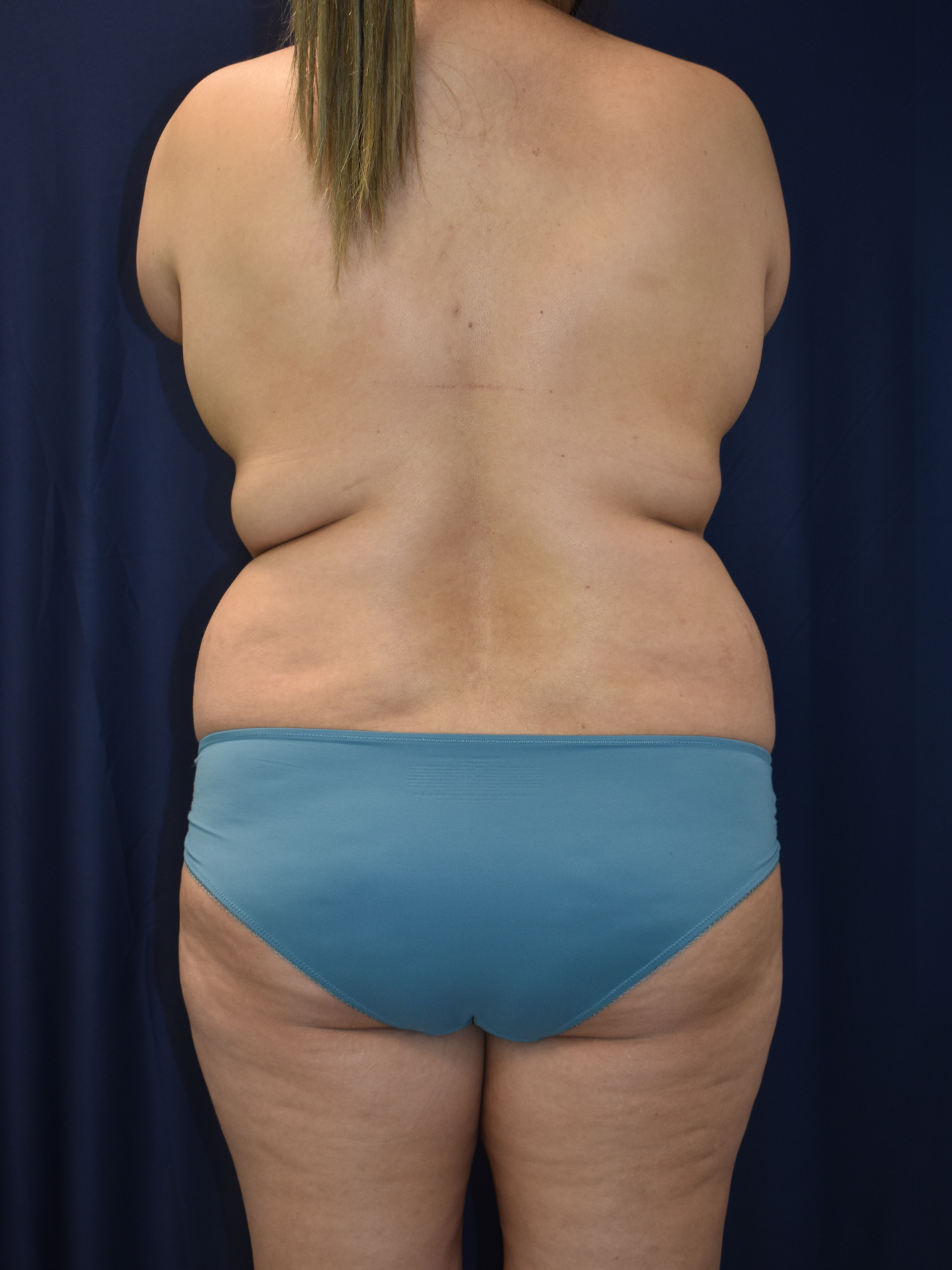 Abdominoplasty (Tummy Tuck) Patient Photo - Case 2969 - before view-2