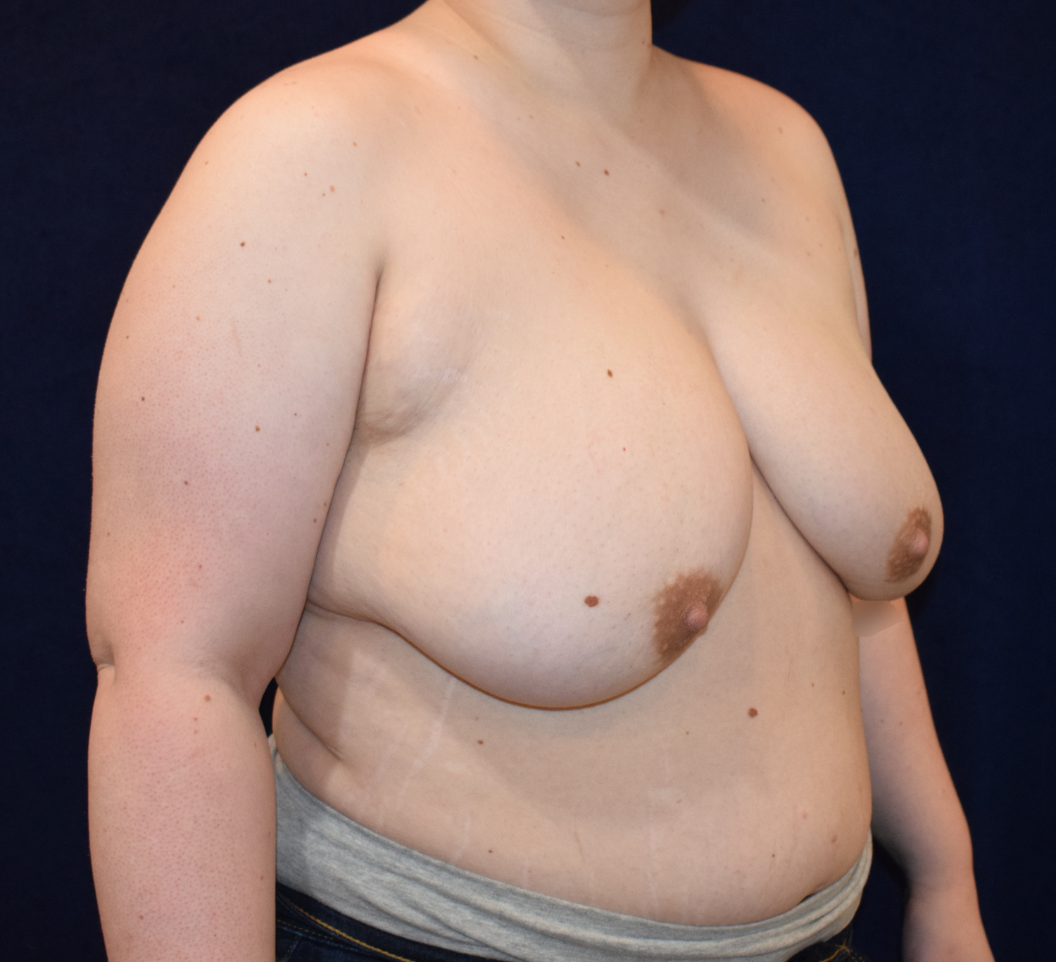 F to M Top Surgery Patient Photo - Case 2977 - before view-1