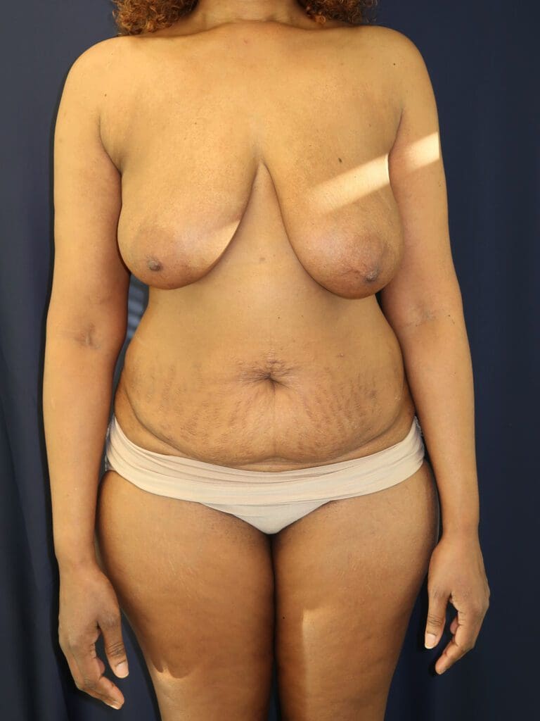 Abdominoplasty (Tummy Tuck) - Case 2985 - Before